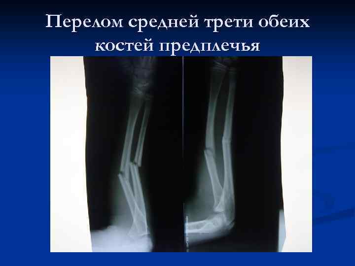 Перелом средней трети обеих костей предплечья 
