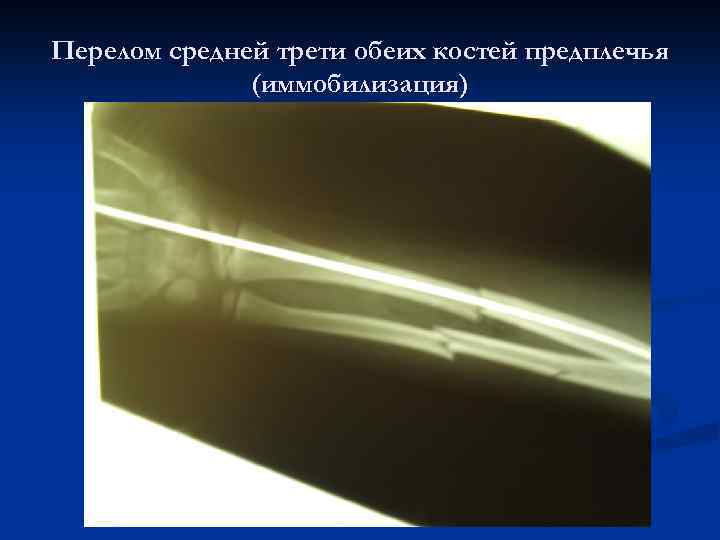 Перелом средней трети обеих костей предплечья (иммобилизация) 