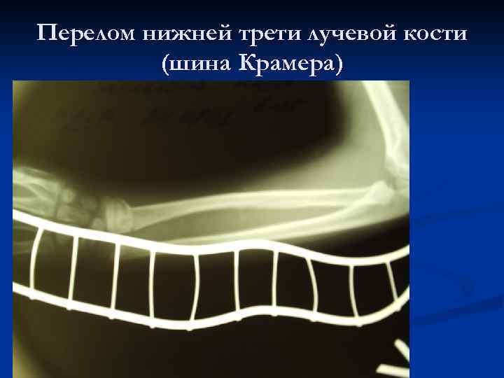 Перелом нижней трети лучевой кости (шина Крамера) 