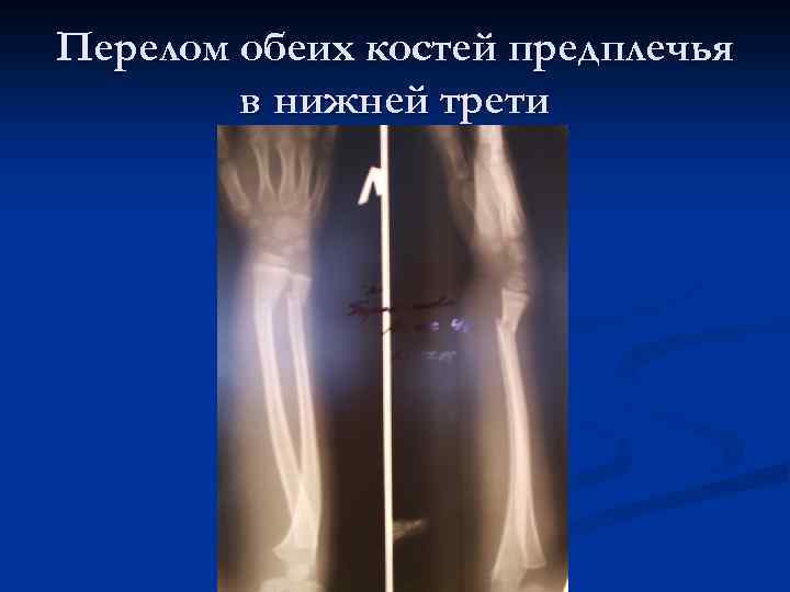 Перелом обеих костей предплечья в нижней трети 