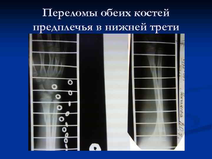 Переломы обеих костей предплечья в нижней трети 