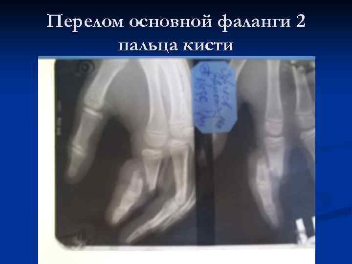 Перелом основной фаланги 2 пальца кисти 