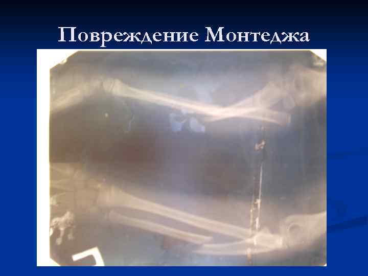 Повреждение Монтеджа 