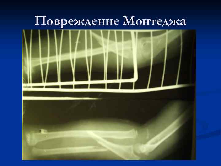 Повреждение Монтеджа 