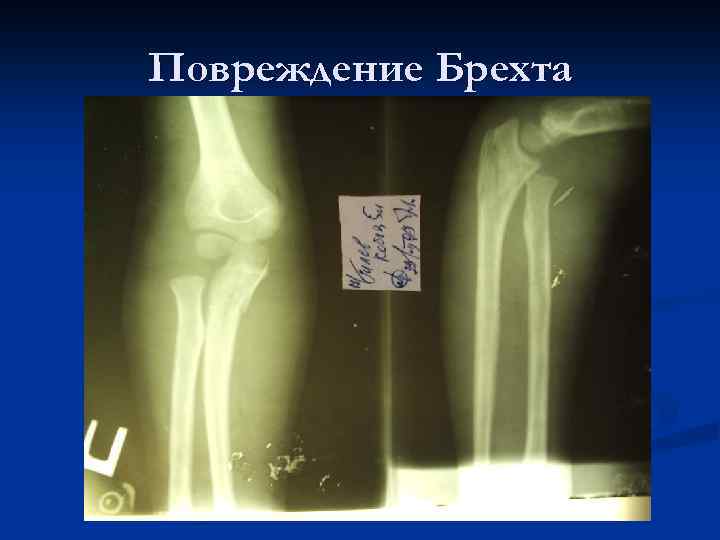 Повреждение Брехта 