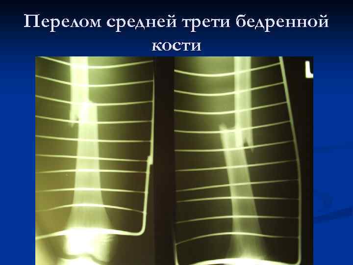 Перелом средней трети бедренной кости 