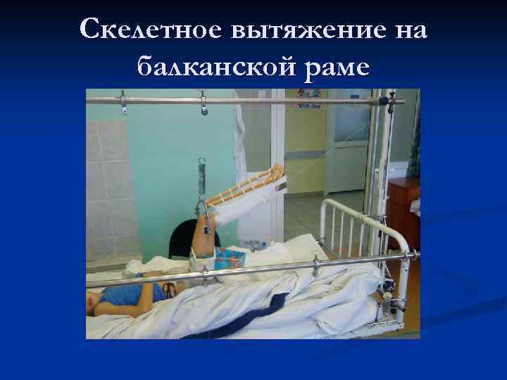 Скелетное вытяжение на балканской раме 