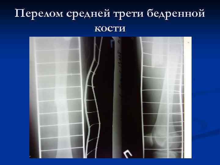 Перелом средней трети бедренной кости 