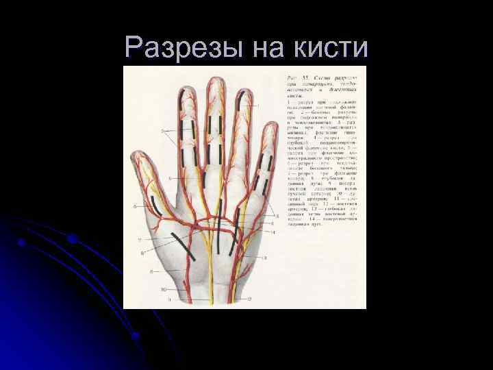 Разрезы на кисти 
