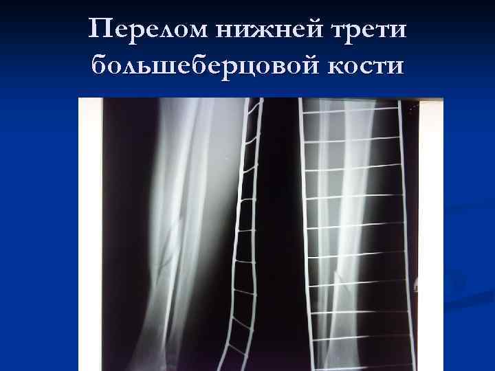 Перелом нижней трети большеберцовой кости 