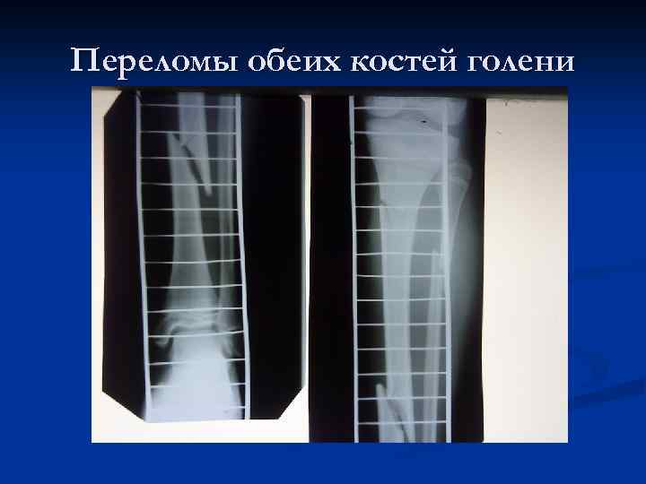 Переломы обеих костей голени 