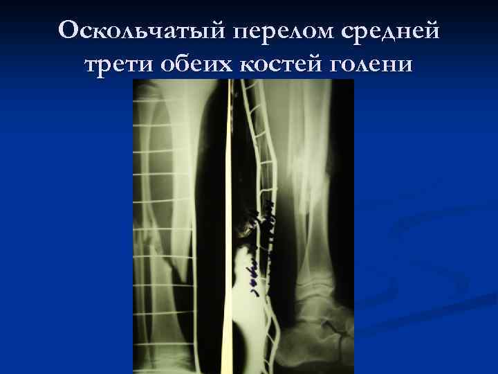 Оскольчатый перелом средней трети обеих костей голени 