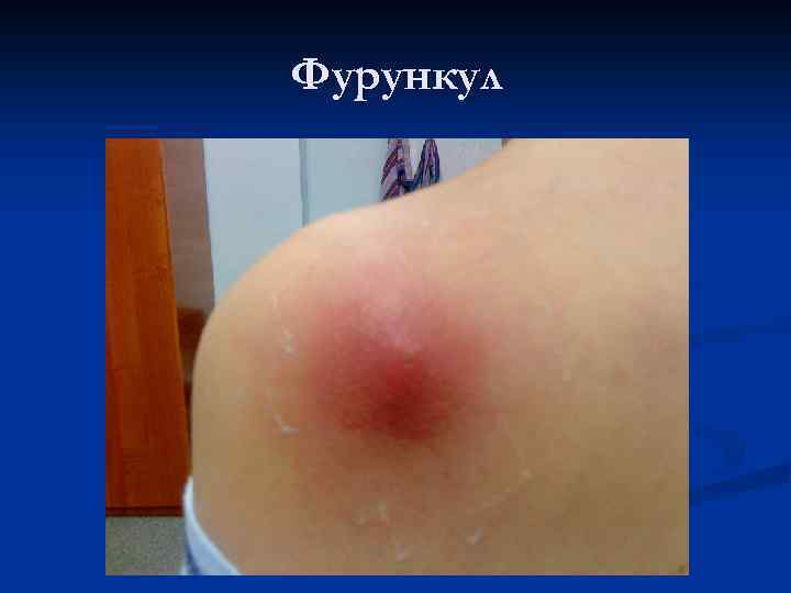 Фурункул 