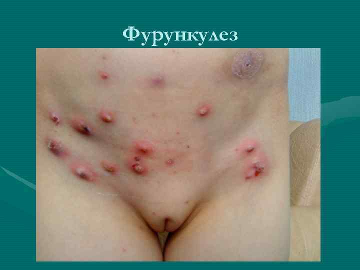 Фурункулез 