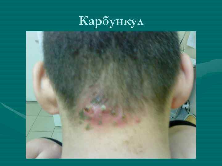 Карбункул 