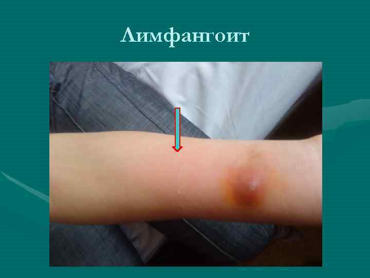 Лимфангоит 