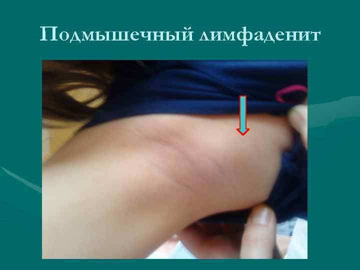 Подмышечный лимфаденит 