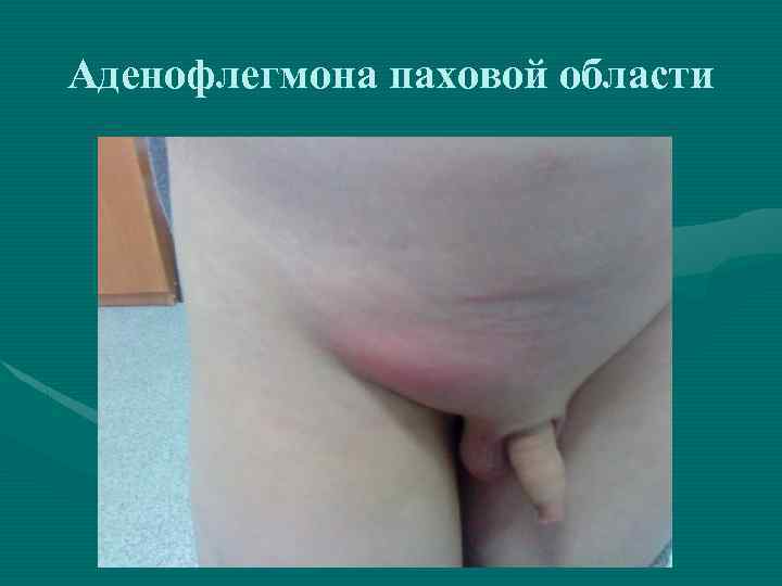 Аденофлегмона паховой области 