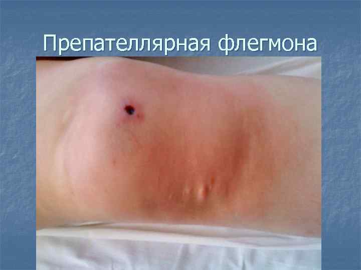 Препателлярная флегмона 