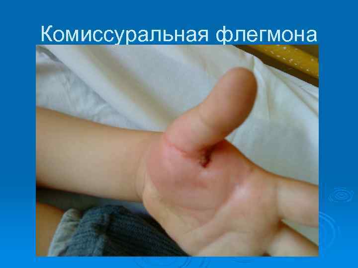 Комиссуральная флегмона 