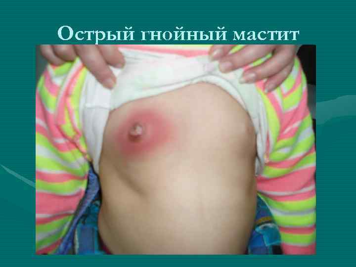 Острый гнойный мастит 