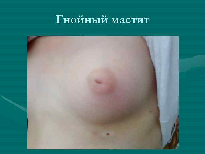 Гнойный мастит 