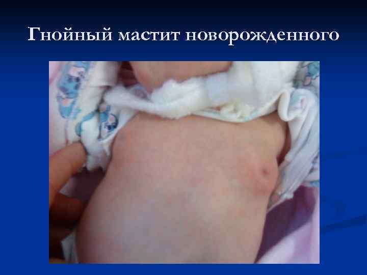 Гнойный мастит новорожденного 