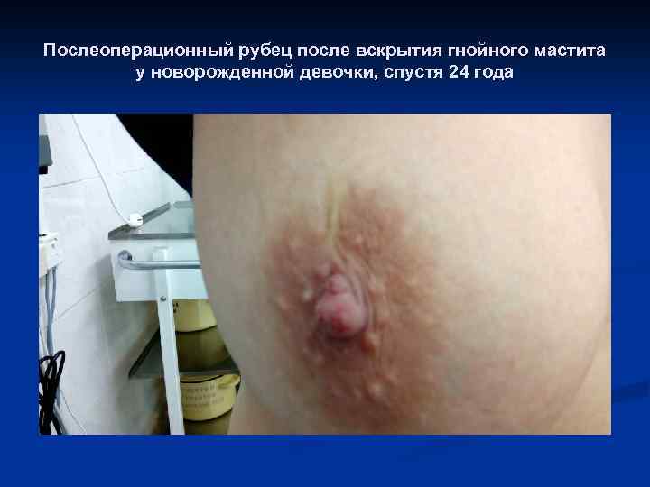 Послеоперационный рубец после вскрытия гнойного мастита у новорожденной девочки, спустя 24 года 