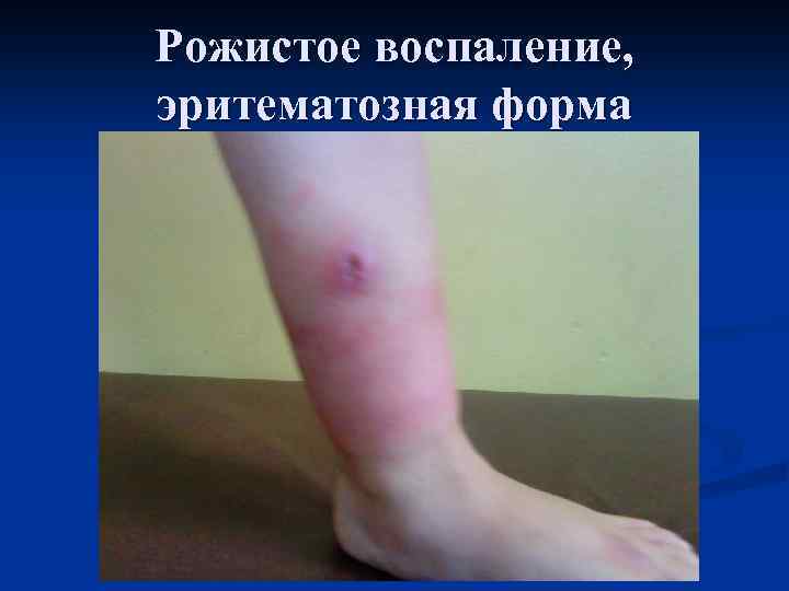 Рожистое воспаление, эритематозная форма 