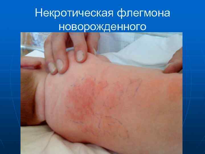 Некротическая флегмона новорожденного 