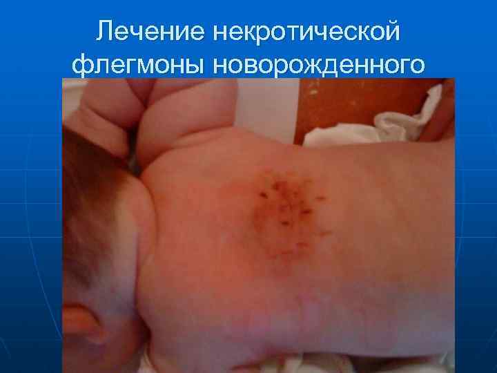 Лечение некротической флегмоны новорожденного 