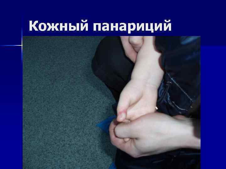 Кожный панариций 