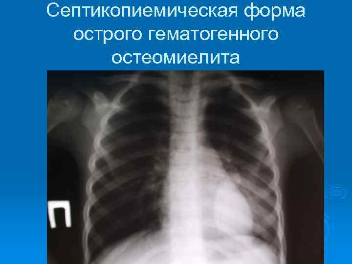 Септикопиемическая форма острого гематогенного остеомиелита 