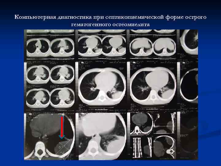 Компьютерная диагностика при септикопиемической форме острого гематогенного остеомиелита 