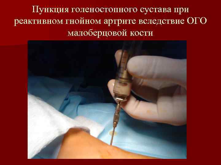 Пункция голеностопного сустава при реактивном гнойном артрите вследствие ОГО малоберцовой кости 