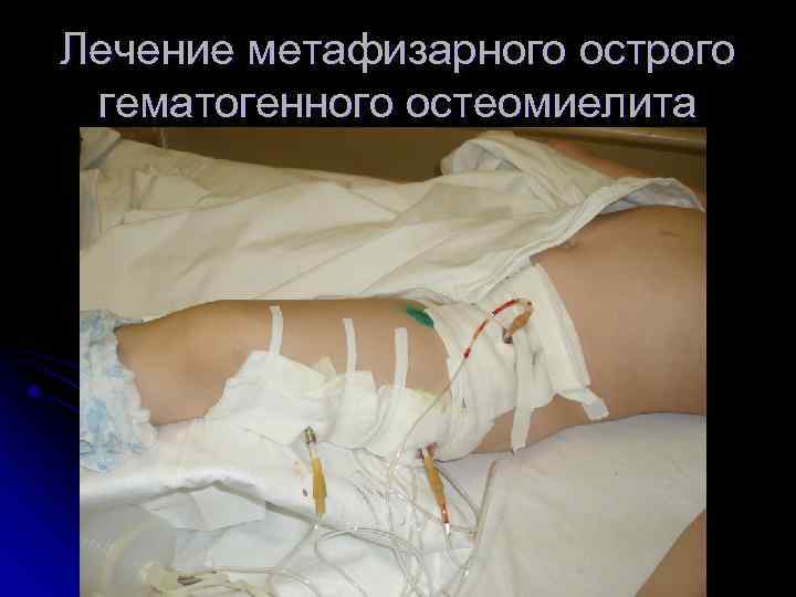 Лечение метафизарного острого гематогенного остеомиелита 