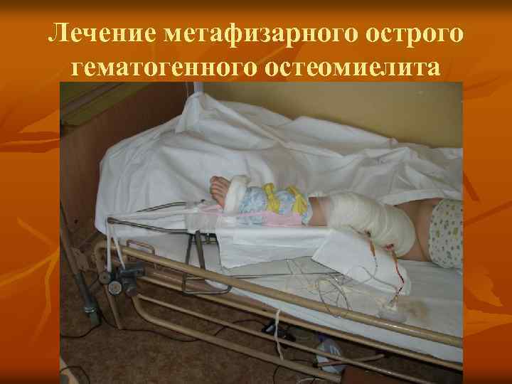 Лечение метафизарного острого гематогенного остеомиелита 
