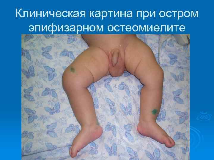 Клиническая картина при остром эпифизарном остеомиелите 