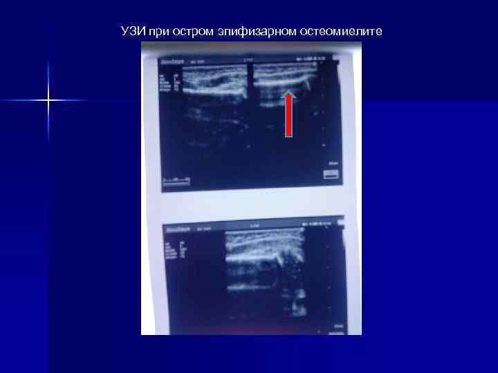 УЗИ при остром эпифизарном остеомиелите 