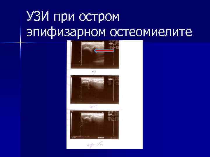 УЗИ при остром эпифизарном остеомиелите 