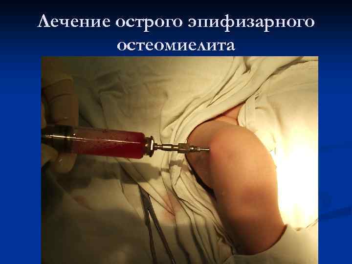 Лечение острого эпифизарного остеомиелита 