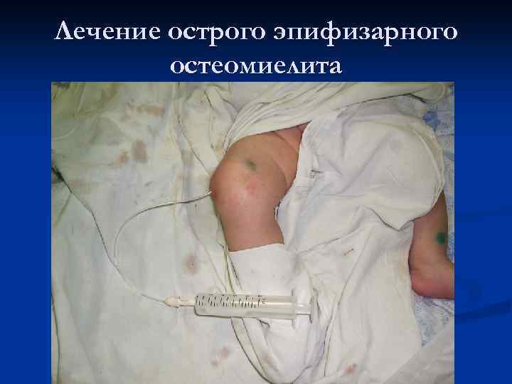 Лечение острого эпифизарного остеомиелита 