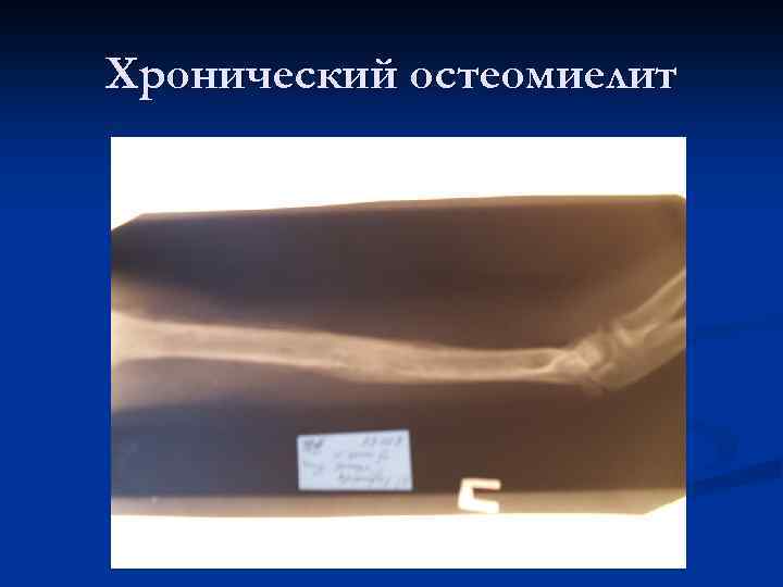 Хронический остеомиелит 