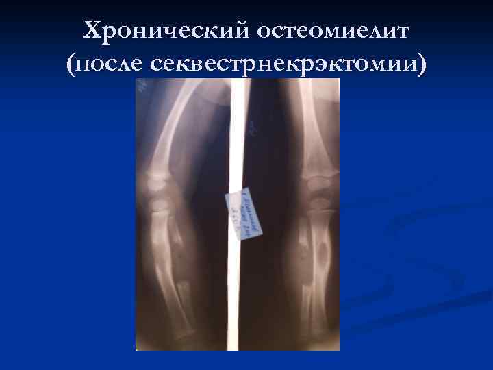 Хронический остеомиелит (после секвестрнекрэктомии) 