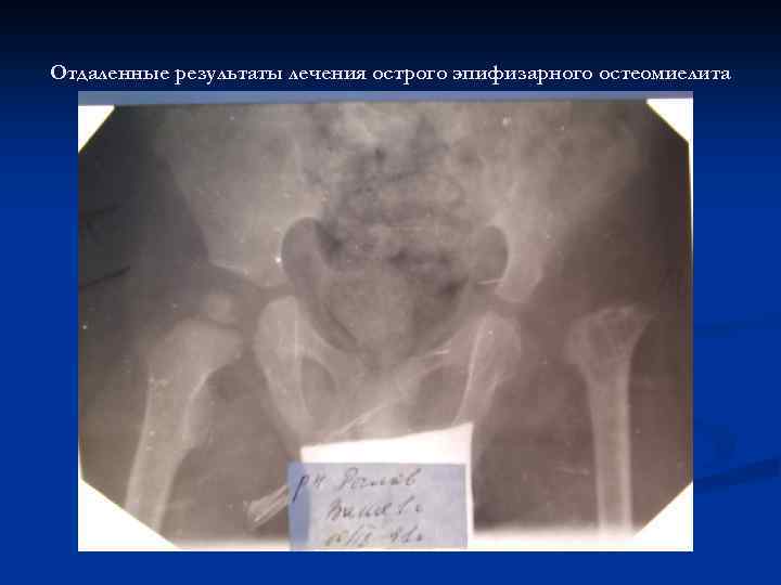 Отдаленные результаты лечения острого эпифизарного остеомиелита 