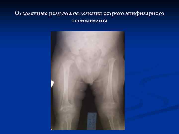 Отдаленные результаты лечения острого эпифизарного остеомиелита 