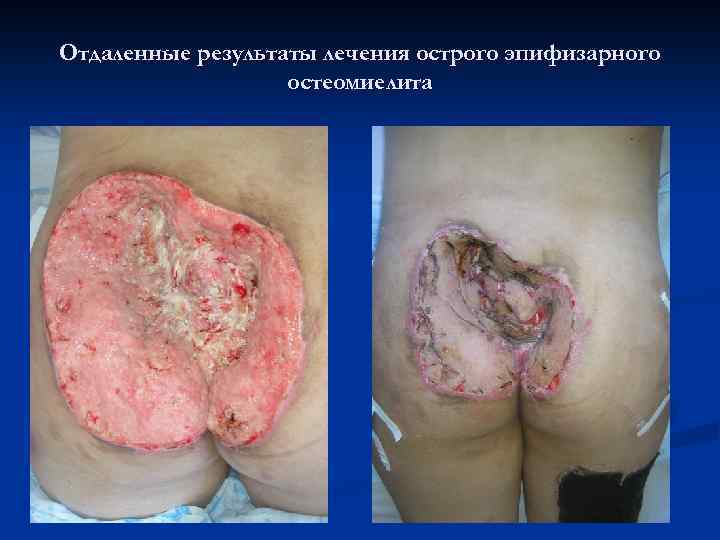 Отдаленные результаты лечения острого эпифизарного остеомиелита 