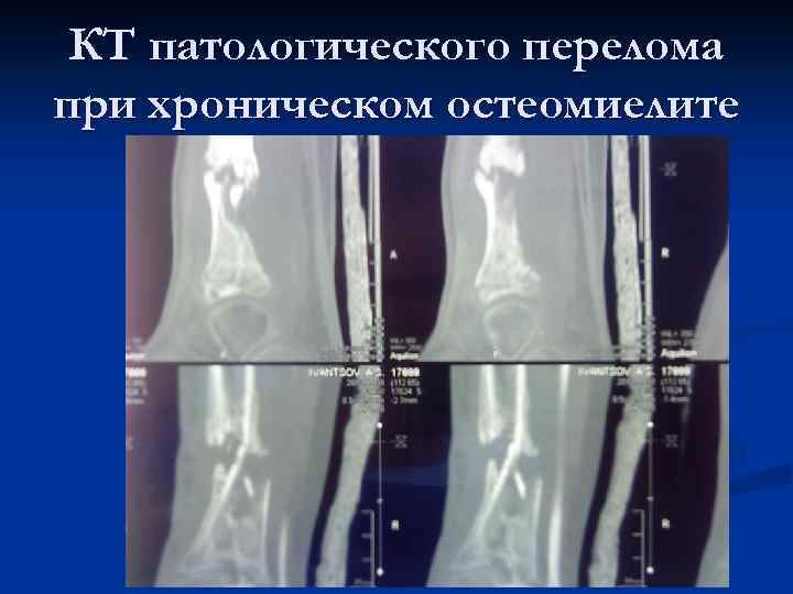 КТ патологического перелома при хроническом остеомиелите 