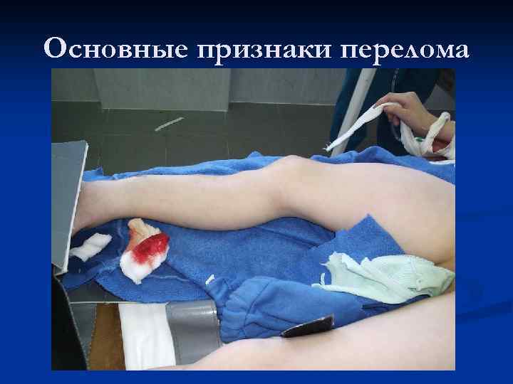 Основные признаки перелома 