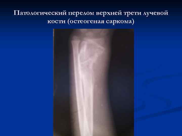Патологический перелом верхней трети лучевой кости (остеогеная саркома) 